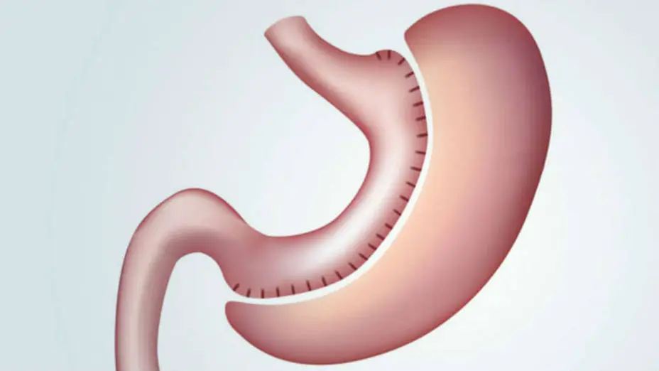 Qué es la manga gástrica